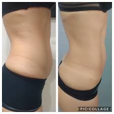 Criomodelagem tratamento estético